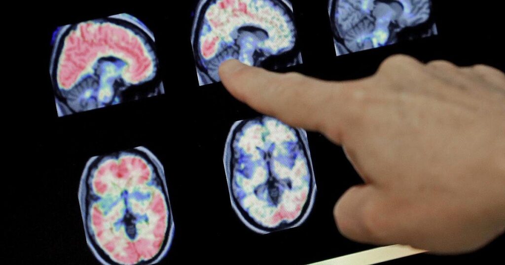 Un impianto cerebrale traduce gesti e parole: una svolta per le persone paralizzate